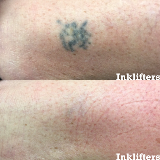 Find palm size tattoo ideas for females for your next unique tattoo in Pleasant Grove at Inklifters Tattoo Removal