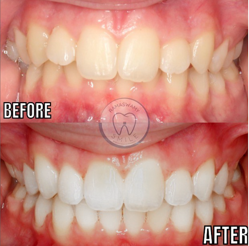 Ramaswamy Smile Orthodontics - Braces, Invisalign Orthodontist image 10