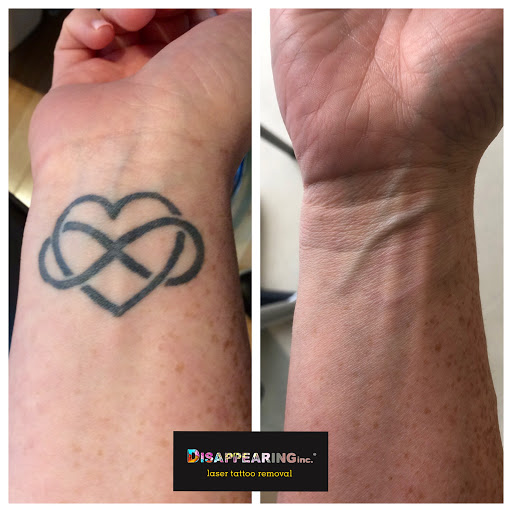 Find poppy tattoo ideas for your next unique tattoo in Lawrence at Removery Tattoo Removal & Fading