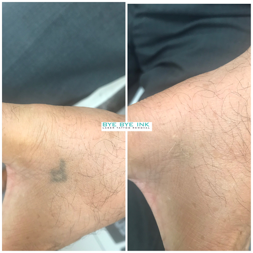 Explore lust tattoo ideas, creative tattoo ideas in Middle Village, available at Bye Bye Ink Laser Tattoo Removal
