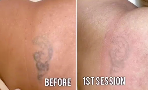 Explore weightlifting tattoos ideas, creative tattoo ideas in Hallandale, available at Laser Treatments by Ageless Body Clinic