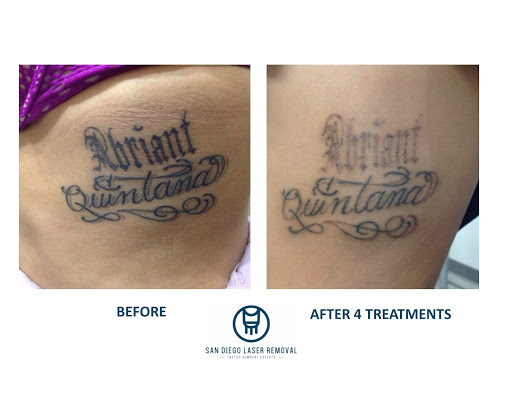 Explore wrist scar tattoo ideas, creative tattoo ideas in San Diego, available at Removery Tattoo Removal & Fading