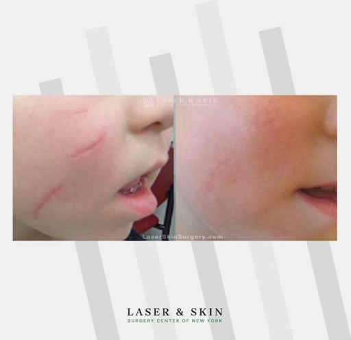 Explore lifeline tattoo ideas, creative tattoo ideas in Southampton, available at Laser & Skin Surgery Center of New York - Southampton