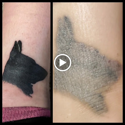 Explore 1 of 1 tattoo ideas, creative tattoo ideas in Dubuque, available at Retrospect Tattoo Removal