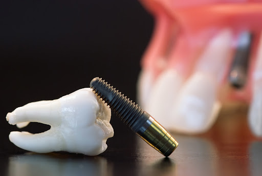 Denture Implants Albany image 2