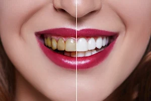 Diş Hekimi Metin Sayın,Diş Hekimi Ali Sayın-Konya implant, Konya zirkonyum, Konya estetik diş, Tedavi, Protez image