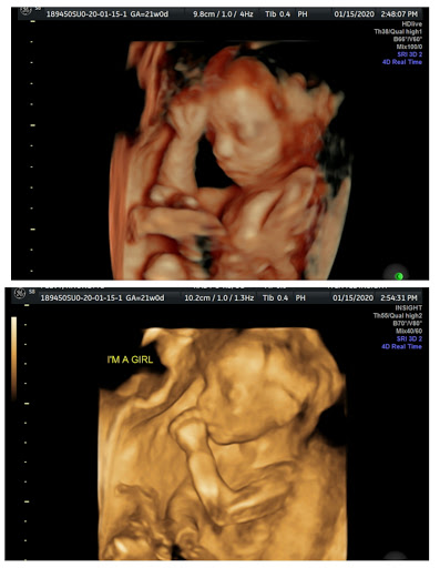 A Little Insight 3D 4D 5D Ultrasound image