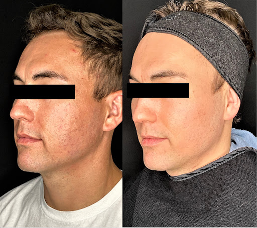 Explore arm tribal tattoo cover up ideas, creative tattoo ideas in Brookfield, available at Milwaukee Laser & Body Aesthetics