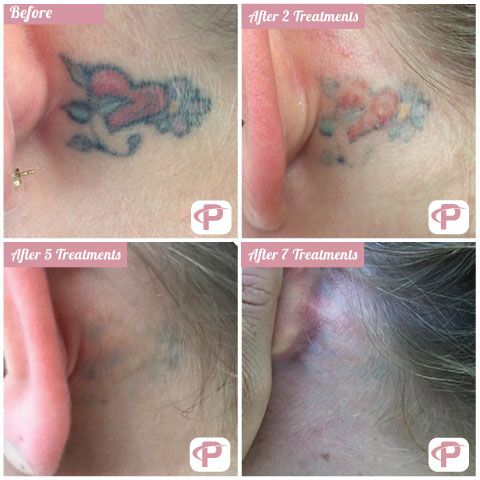 Find family of 3 tattoo ideas for your next unique tattoo in Houston at Premium Tattoo Removal