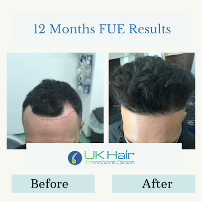UK Hair Transplant Clinics Birmingham - UK Hair Transplant Clinics Birmingham