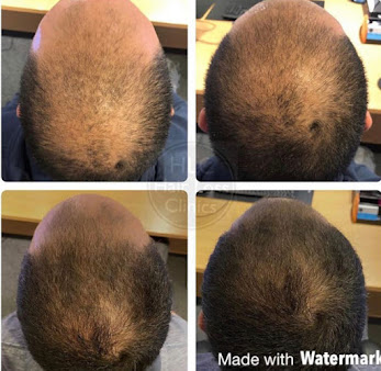 عيادات تساقط الشعر - كارلايل - The Hair Loss Clinics - Carlisle