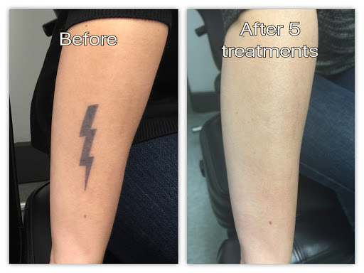 Explore tattoo ideas for lost brother, creative tattoo ideas in Honolulu, available at Removery Tattoo Removal & Fading