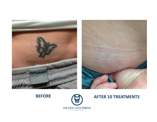 Explore tattoo ideas for men easy, creative tattoo ideas in San Diego, available at Removery Tattoo Removal & Fading