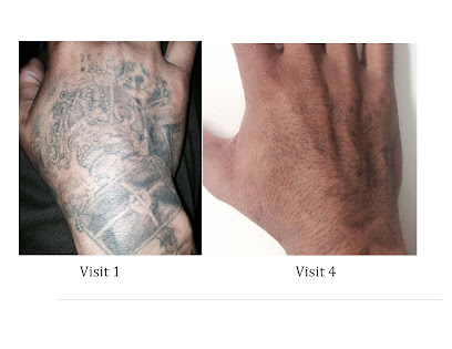 Tattoo Removal Inc