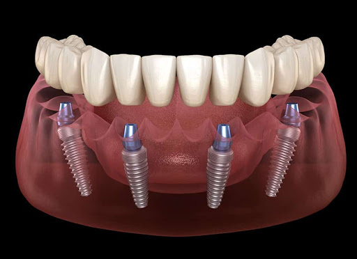 Parkview Dental & Dental Implant centre