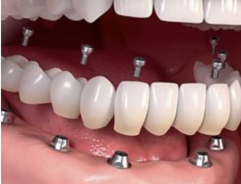Clínica de Implantología Oral Del Valle