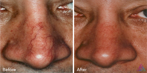 Explore black queen tattoo ideas, creative tattoo ideas in Glenwood Springs, available at Lifestyle Laser