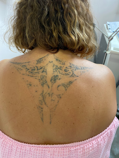 Explore scoliosis tattoo ideas, creative tattoo ideas in Naples, available at Laser Tattoo Removal Services