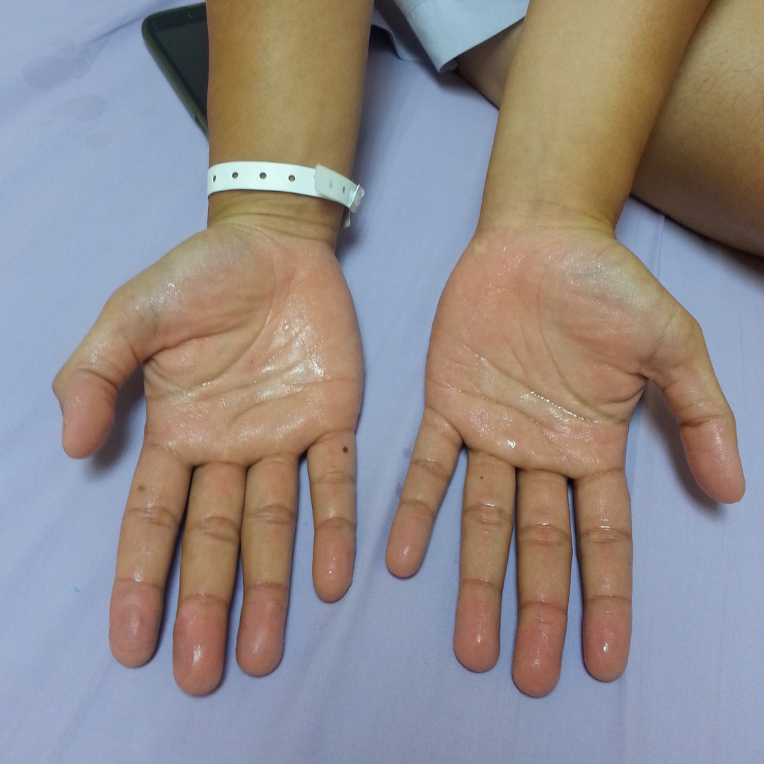 Hyperhidrosis Malaysia