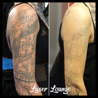 Laserlounge-Tattoo fjernelse