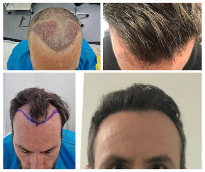 عيادات أفضل لزراعة الشعر - برمنغهام - Better Hair Transplant Clinics - Birmingham