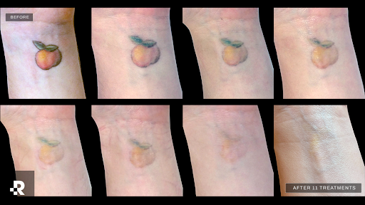 Explore mens knee tattoo ideas, creative tattoo ideas in Santa Ana, available at Removery Tattoo Removal & Fading