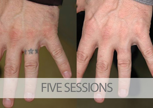 Explore avocado tattoo ideas, creative tattoo ideas in Palm Harbor, available at EradiTatt Tattoo Removal of Palm HarborClearwater