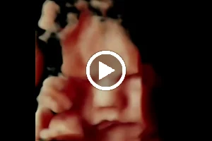 Blushing Baby 3D/4D Ultrasound image