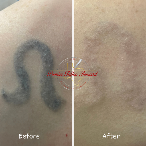 Explore tattoo design idea generator, creative tattoo ideas in Mckinney, available at Premier Tattoo Removal