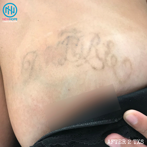 Explore bakugou tattoo ideas, creative tattoo ideas in Westminster, available at Newhope Laser Skin Care