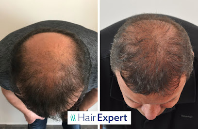 HairExpert - transplantace vlasů s doživotní zárukou