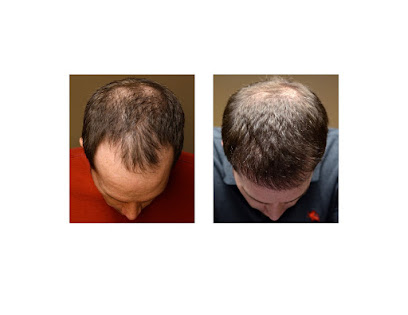 Bosley - Hair Restoration & Transplant