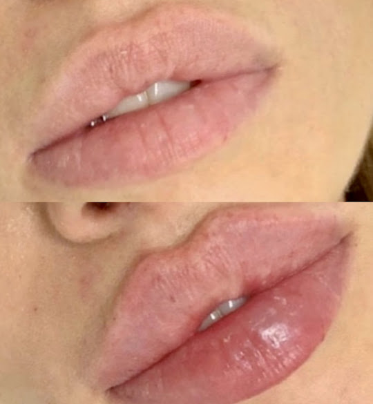 Lip augmentation specialist in Central LA thumbnail