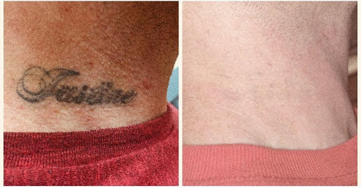 Explore vegas tattoo ideas, creative tattoo ideas in Pinellas Park, available at St Pete Tattoo Removal