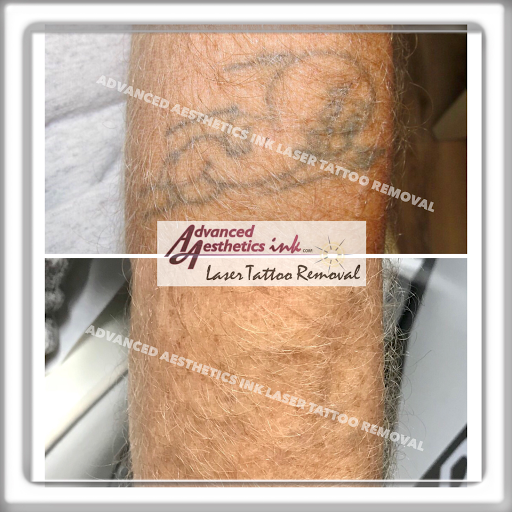 Explore snowboard tattoo ideas, creative tattoo ideas in South Dartmouth, available at Advanced Aesthetics Ink Laser Tattoo Removal