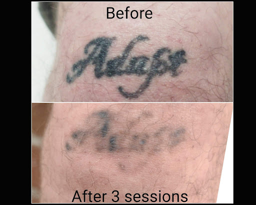 Explore tattoo cover up ideas chest, creative tattoo ideas in Brighton, available at Tip of the Spear Laser Esthetics