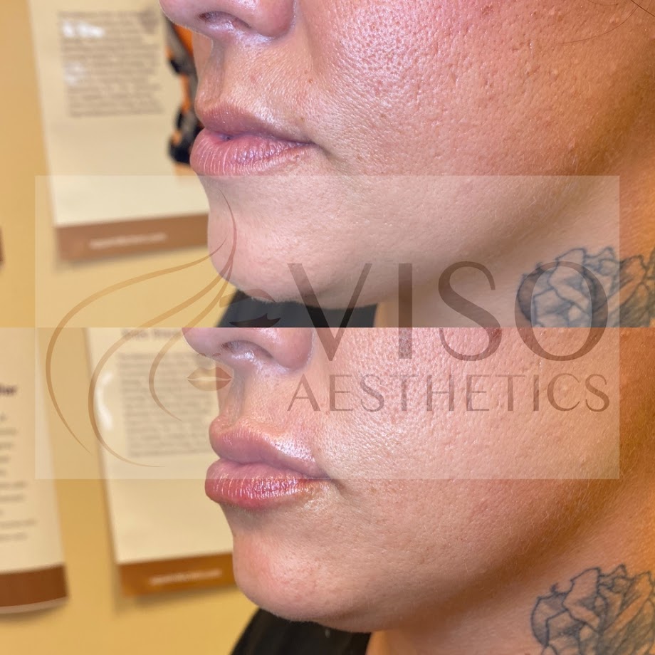 Botox and Lip Fillers by Viso Aesthetics