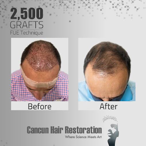 كانكون استعادة الشعر - Cancun Hair Restoration
