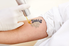 UNDO - Tattoo verwijderen & Laser ontharing