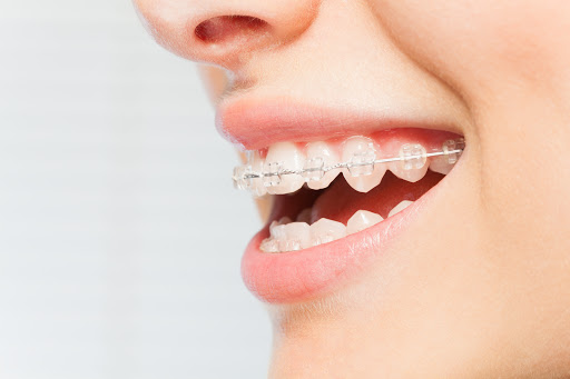 Orthodontist Glendale