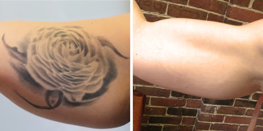 Explore crossword tattoo ideas, creative tattoo ideas in New York, available at Removery Tattoo Removal & Fading