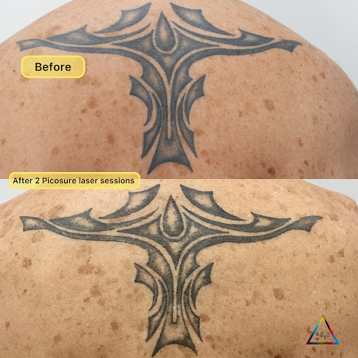 Explore logger tattoo ideas, creative tattoo ideas in New York, available at Ag2g Laser Tattoo Removal & MedSpa