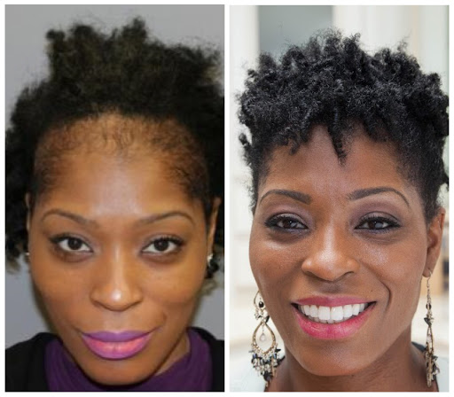 Hair Transplantation Clinic «Bosley Medical - Denver», reviews and photos, 6979 S Holly Cir #275, Centennial, CO 80112, USA