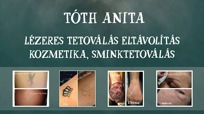 Lézeres Tetoválás eltávolítás Picosure és kozmetika Tóth Anita - Budapest