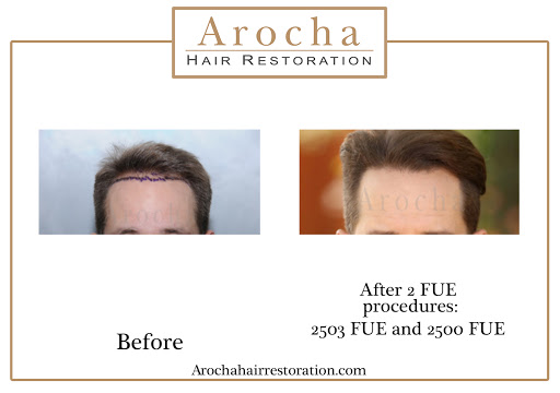 Arocha Hair Restoration