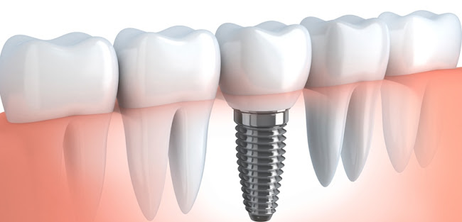 Opinii despre Clinică de Implantologie si Chirurgie OMF Dr Bozocea în <nil> - Dentist