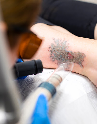 Explore fighting rooster tattoo ideas, creative tattoo ideas in Amarillo, available at Progress MD Tattoo Removal