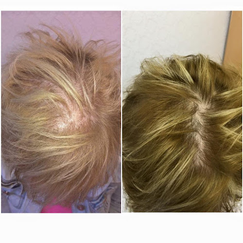 Hair Loss Clinic - Preston