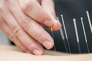 Acupuncture with over 40 years experience - Dr. Shan Kong image