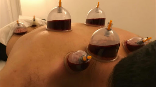 Hijama Therapy Cupping Clinic